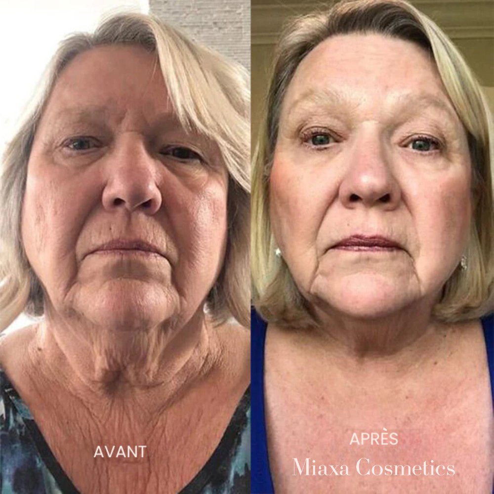 Kit Micro-Infusion Miaxa™ Solution Anti-Âge