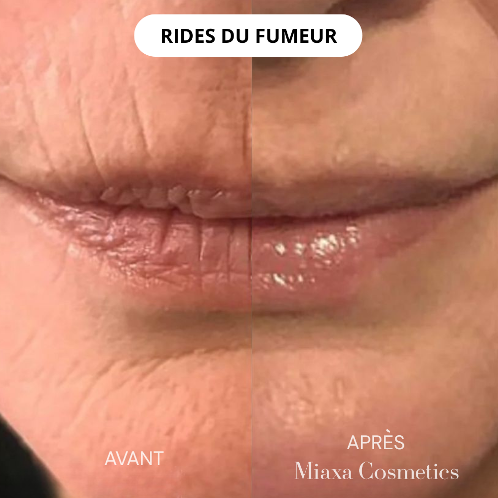 Kit Micro-Infusion Miaxa™ Solution Anti-Âge