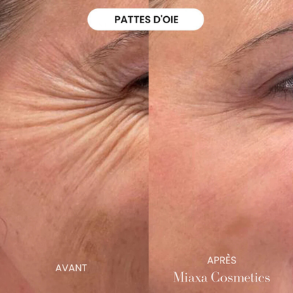Kit Micro-Infusion Miaxa™ Solution Anti-Âge